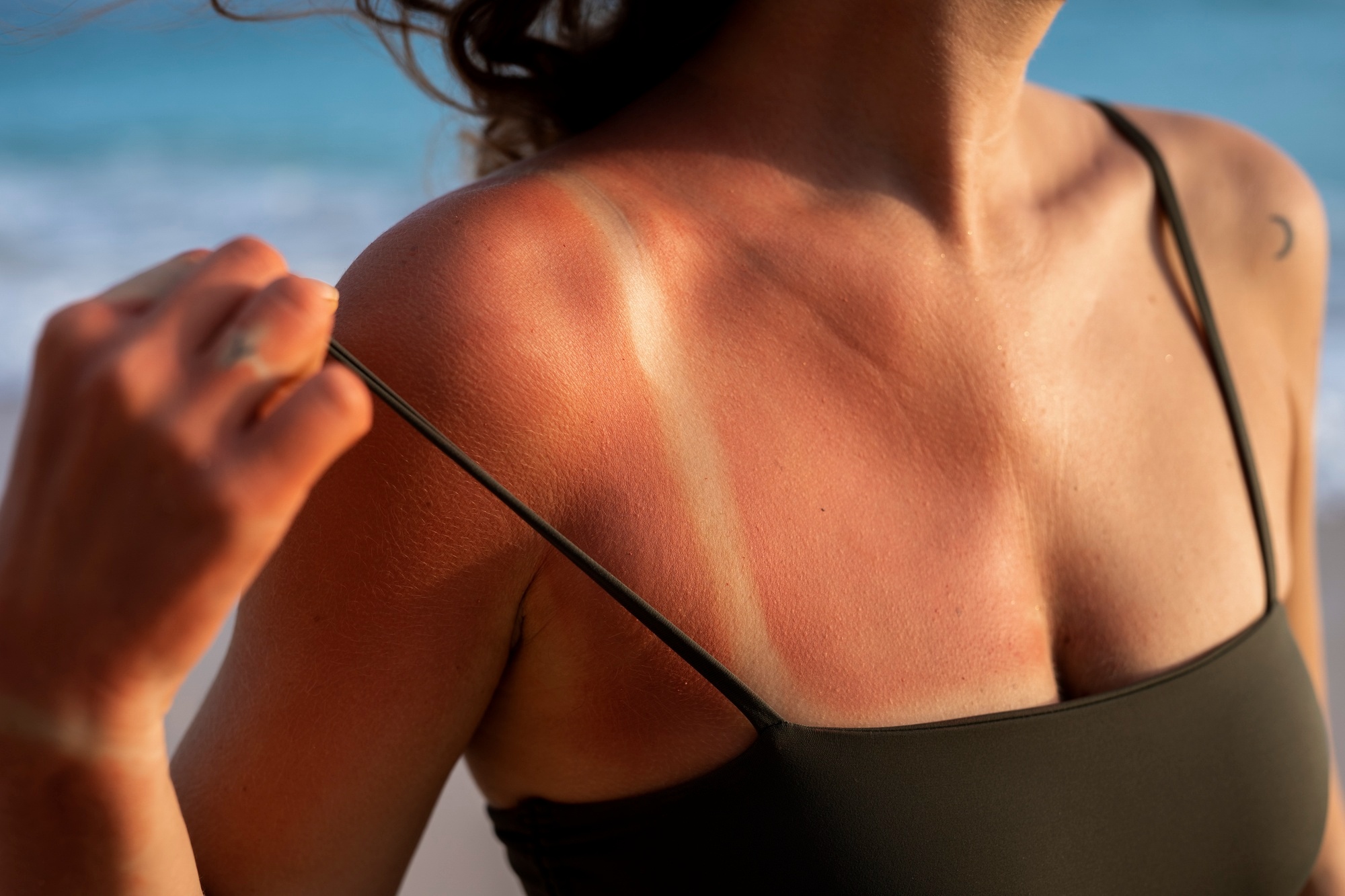 woman having a sunburn